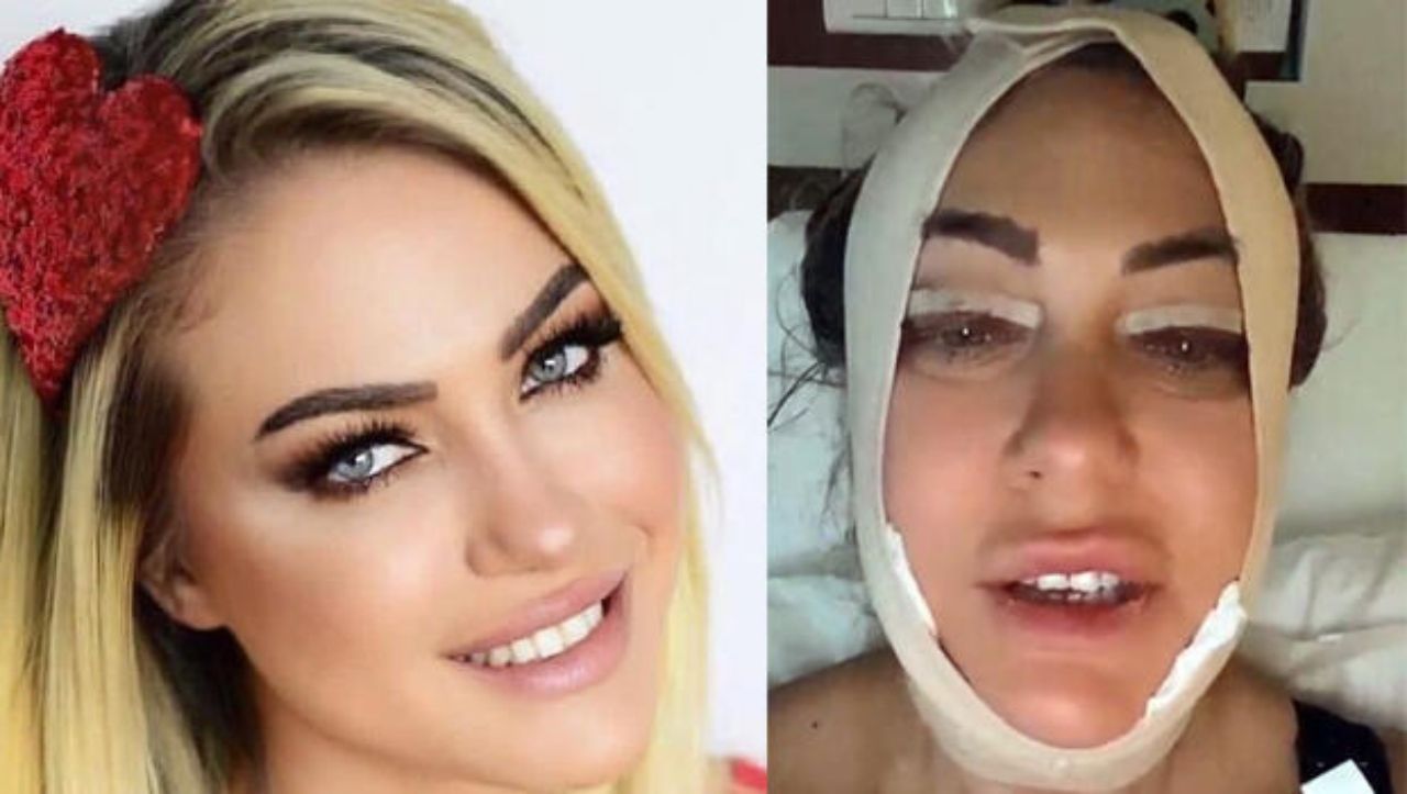 Yeliz Yeşilmen estetik operasyonu geçirdi: 'Hem para veriyorsunuz, hem acı çekiyorsunuz’ - Sayfa:1