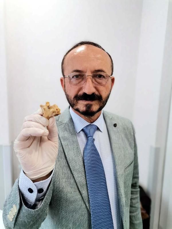 Özbek hasta'nın böbreğinden geyik boynuzu çıktı - Sayfa:3