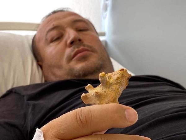 Özbek hasta'nın böbreğinden geyik boynuzu çıktı - Sayfa:1